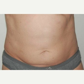 45-54 year old woman treated with CoolSculpting after 1570556
