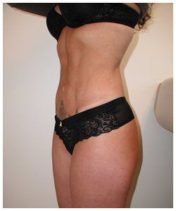 Liposulpture of abdomen, waist, flanks and inner thighs. after 334381