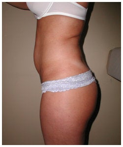 Liposulpture of abdomen, waist, flanks and inner thighs. before 334381