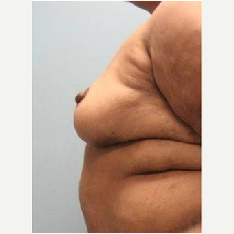 71 year old woman treated with Body Lift after 3680306