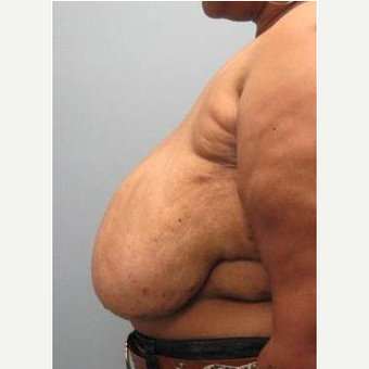 71 year old woman treated with Body Lift before 3680306