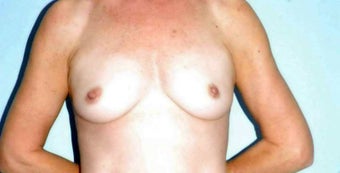 52 year old female, Autologous breast augmentation before 1437912