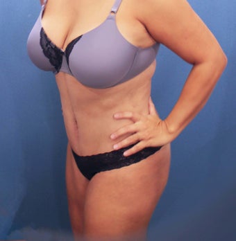 35-44 year old woman treated with Tummy Tuck after 2526011
