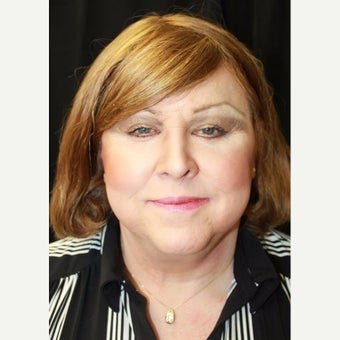 35-44 year old woman treated with Facial Feminization Surgery after 2588860