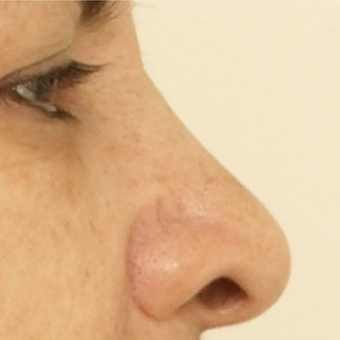 45-54 year old woman treated with Revision Rhinoplasty before 3584890