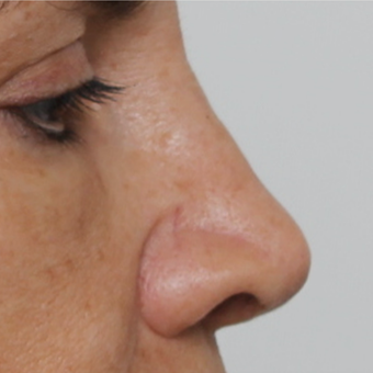 45-54 year old woman treated with Revision Rhinoplasty after 3584890