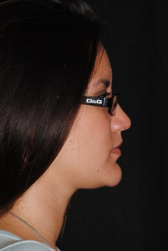 24 year old female concernced with double chin and loss of jaw definition 1279394