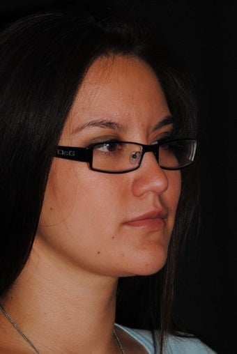 24 year old female concernced with double chin and loss of jaw definition before 1279394