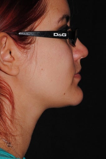 24 year old female concernced with double chin and loss of jaw definition 1279394