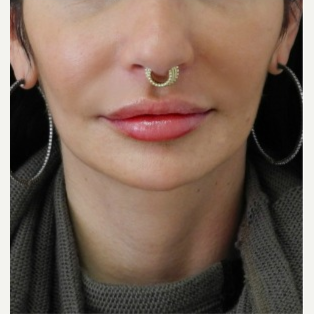 35-44 year old woman treated with Restylane after 3300521