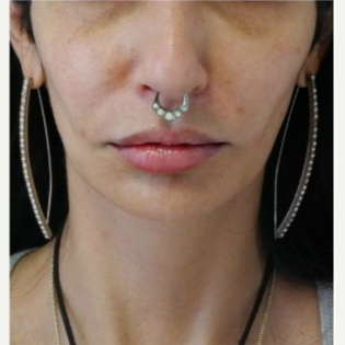 35-44 year old woman treated with Restylane before 3300521
