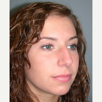 18-24 year old woman treated with Rhinoplasty before 3692284