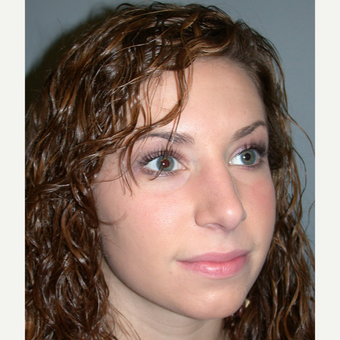 18-24 year old woman treated with Rhinoplasty after 3692284