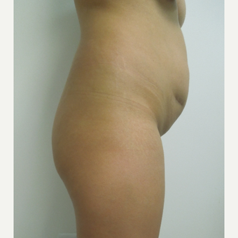 35-44 year old woman treated with Tummy Tuck before 2956192