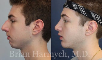 19 year-old male before and 9 months after Rhinoplasty and Chin Implant before 3447237