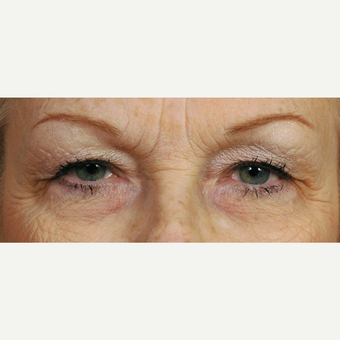 65-74 year old woman treated with Eyelid Surgery before 3454148