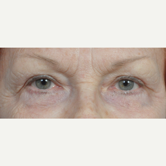 65-74 year old woman treated with Eyelid Surgery after 3454148