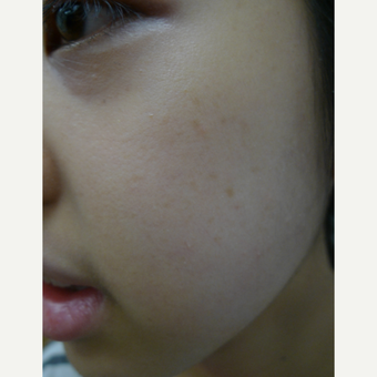 IPL for freckles after 3125248