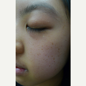 IPL for freckles before 3125248
