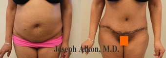 Revision Tummy Tuck before 1200018