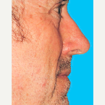 Rhinoplasty before 3814336