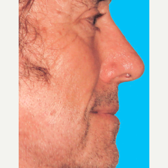 Rhinoplasty after 3814336