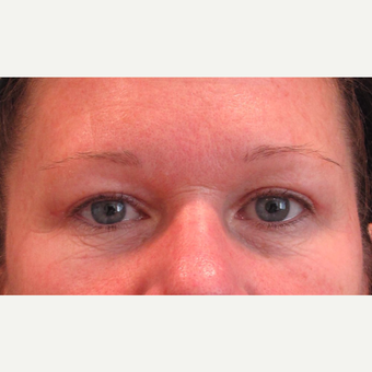 45-54 year old woman treated with Eyelid Surgery after 3713514