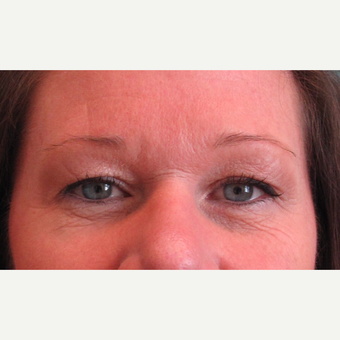 45-54 year old woman treated with Eyelid Surgery before 3713514
