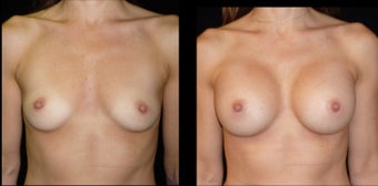 25-34 year old woman treated with Breast Implants before 3498190