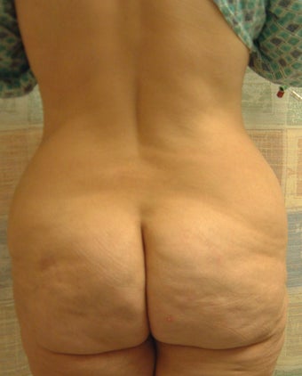 54 year old woman has Belt Lipectomy 984190