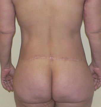 54 year old woman has Belt Lipectomy 984190
