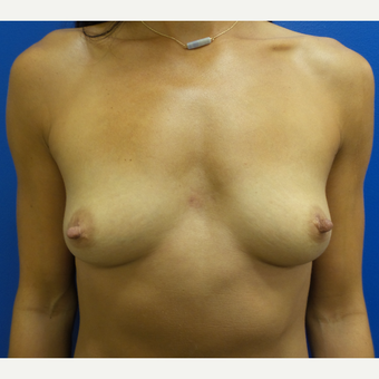25-34 year old woman treated with Breast Augmentation before 3293232