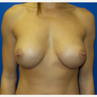 25-34 year old woman treated with Breast Augmentation after 3293232