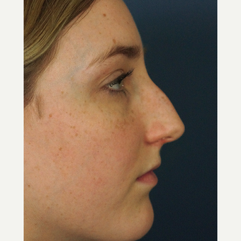 18-24 year old woman treated with Rhinoplasty before 3245067