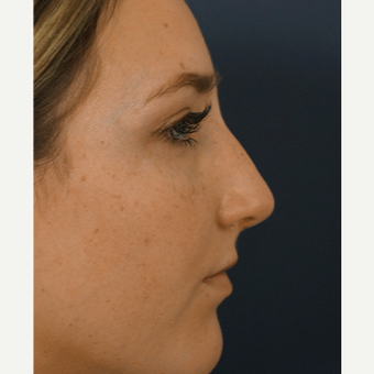 18-24 year old woman treated with Rhinoplasty after 3245067