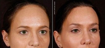 45-54 year old woman before and after hairline lowering browlift and fat grafting before 1643701