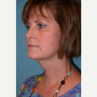 45-54 year old woman treated with Facelift after 3732704