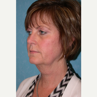 45-54 year old woman treated with Facelift before 3732704