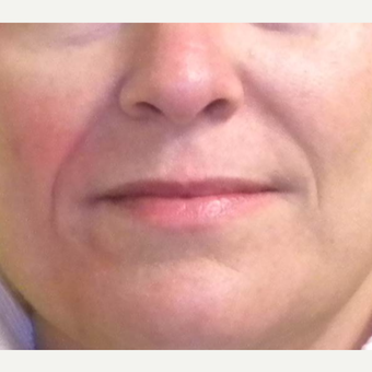 45-54 year old woman treated with Restylane before 3372372