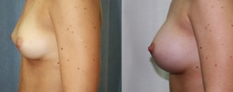A 27 year female underwent correction of inverted nipple along with Breast Augmentation before 932057