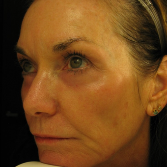 55-64 year old woman treated with Eye Bags Treatment after 3441395