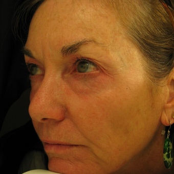 55-64 year old woman treated with Eye Bags Treatment before 3441395