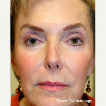 55-64 year old woman treated with Radiesse after 2261368