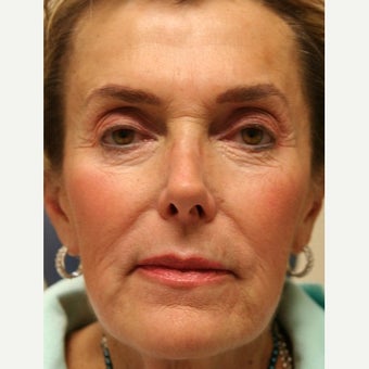 55-64 year old woman treated with Radiesse before 2261368