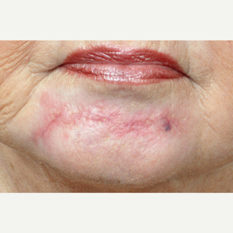65-74 year old woman treated with Scar Removal before 3696808