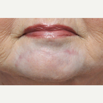 65-74 year old woman treated with Scar Removal after 3696808