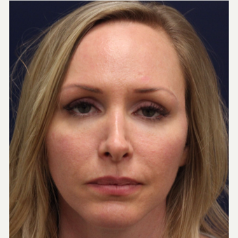 25-34 year old woman treated with Bellafill after 3143390