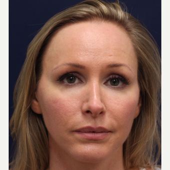 25-34 year old woman treated with Bellafill before 3143390