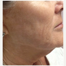 55-64 year old woman treated with Infini RF after 3642486