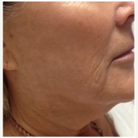 55-64 year old woman treated with Infini RF before 3642486